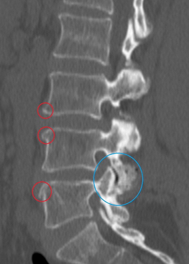 Начальный спондилез. Спондилоартроз грудного отдела на рентгене. Спондилез поясничного отдела рентген. Деформирующий спондилез l2 l5. Спондилез и остеохондроз поясничного отдела позвоночника.